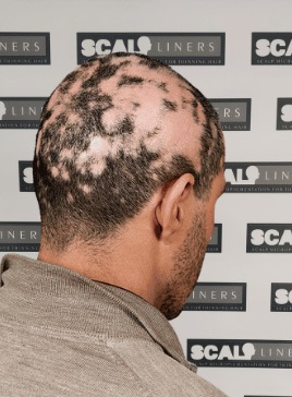 Scar Camouflage At Scalpliners SMP Kent