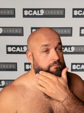 SMP aftercare treatment at Scalpliners