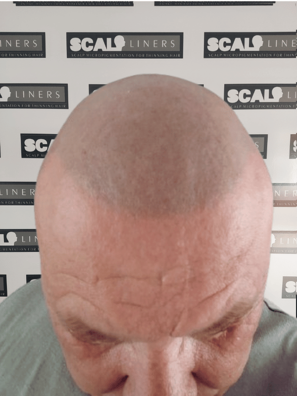 Professional SMP treatment - Hair tattoo solution in Kent