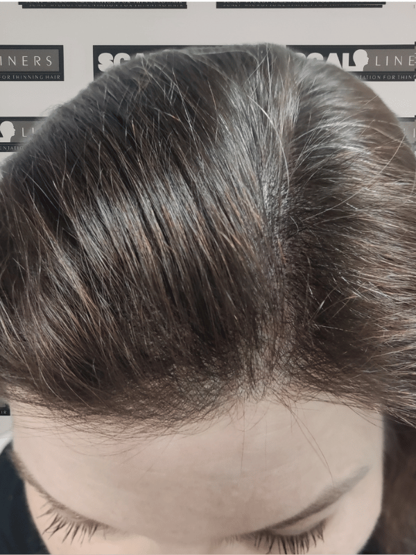 Effective SMP for receded hairline in Whitstable, Kent
