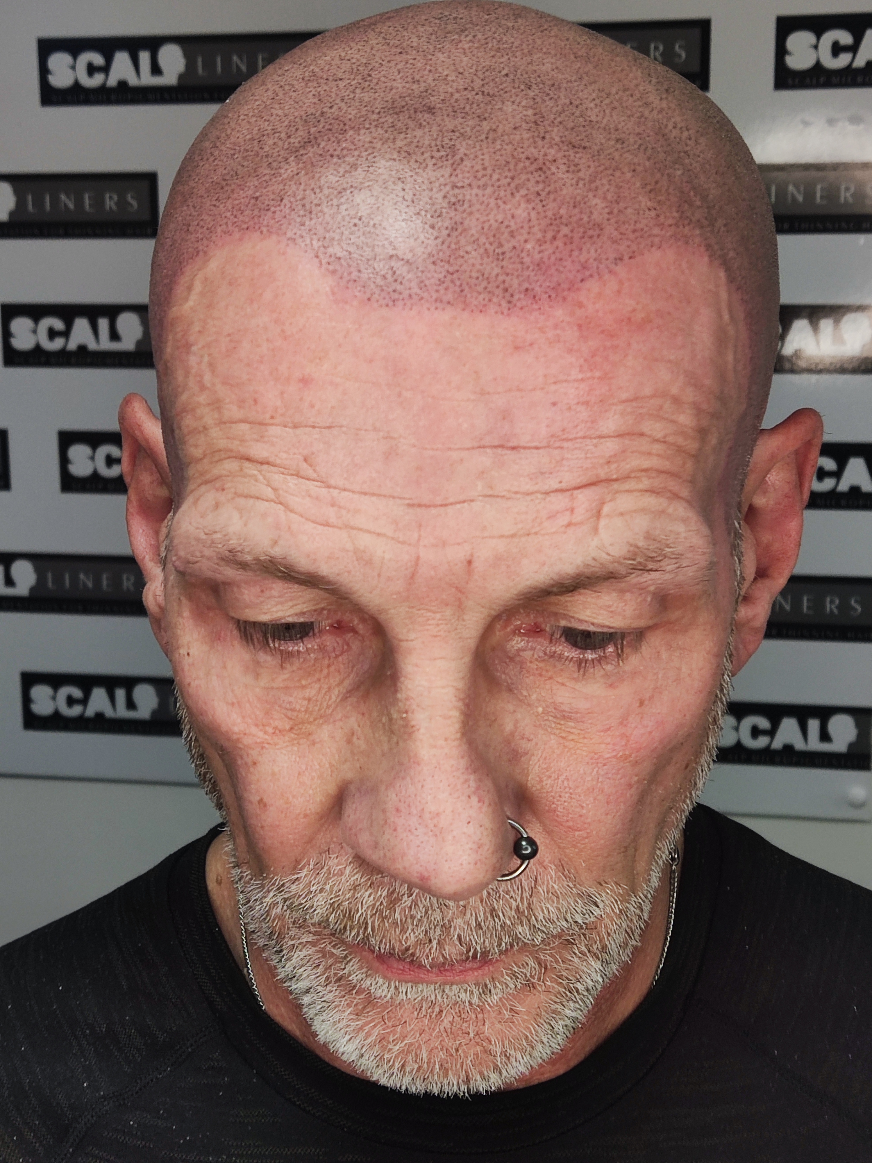 Professional SMP result for alopecia treatment in Whitstable, Kent