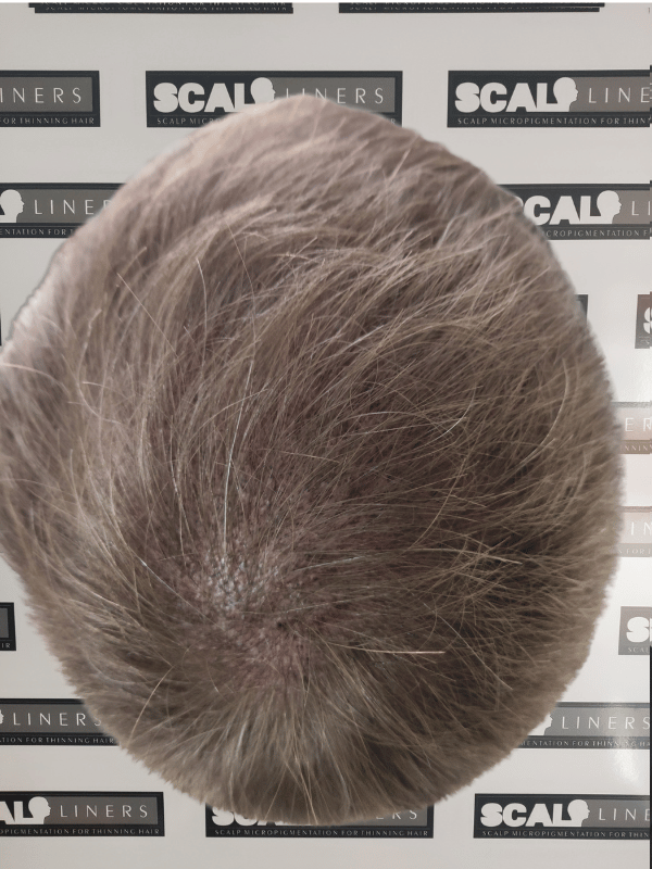 Expert SMP treatment for natural hair restoration in Kent