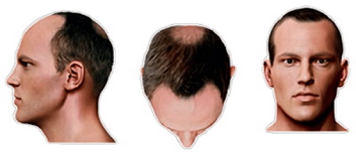 Stage 3 Hair Loss SMP Treatment