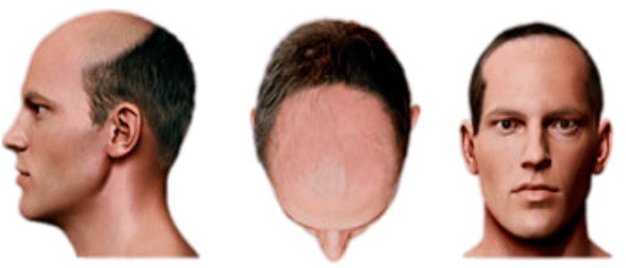 Stage 4 Hair Loss SMP Treatment