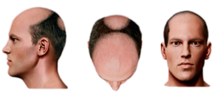 Stage 5 Hair Loss SMP Treatment
