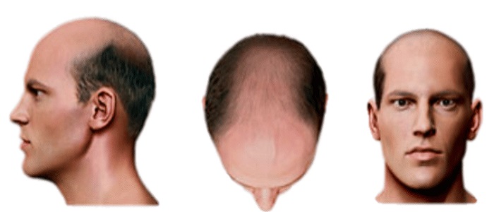 Stage 6 Hair Loss SMP Treatment
