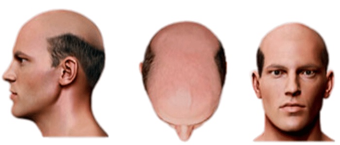 Stage 7 Hair Loss SMP Treatment