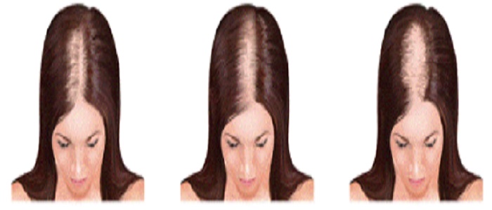 Women's Hair Loss SMP Treatment