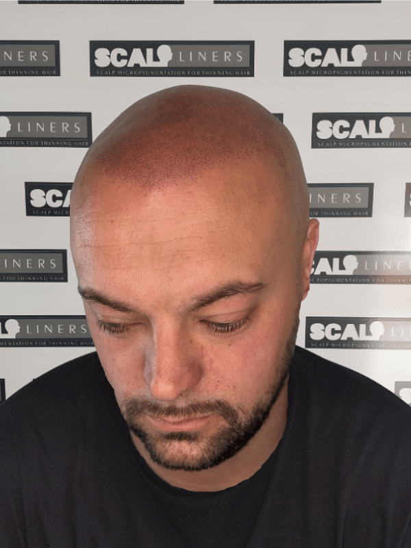 Before/after scalp micropigmentation in Kent
