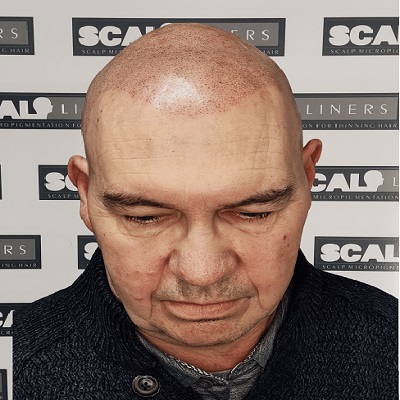 scalpliners-scalpmicropigmentation-testimonial