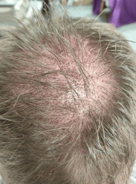 Why Choose Scalpliners for Thinning Hair?